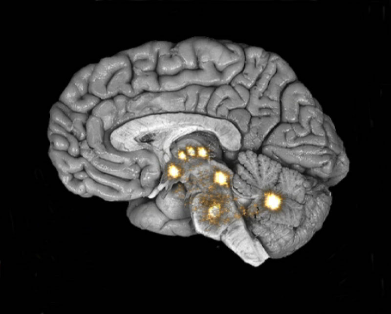 Picture of the human brain with highlighted areas when pain signals subside