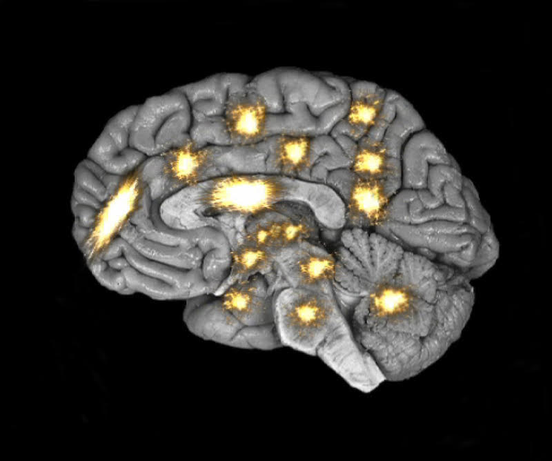 Picture of the human brain with highlighted areas when pain is chronic
